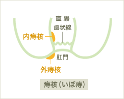 痔核(いぼ痔)