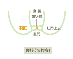 裂肛(切れ痔)