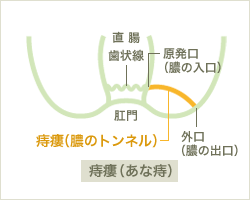 痔瘻(あな痔)